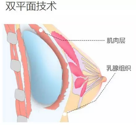 美莱私人定制丰胸 打造性感美胸胸